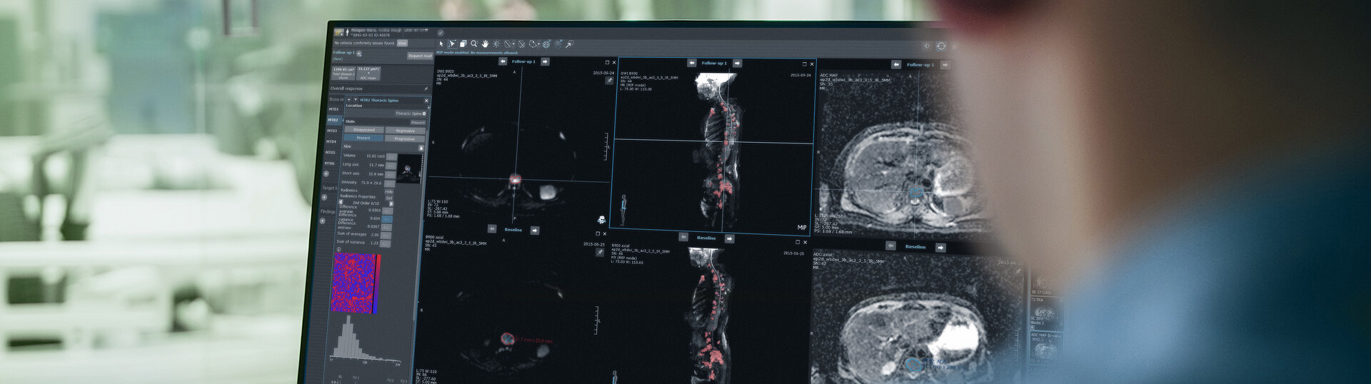 Software für die Radiologie mint Lesion zeigt Bilder aus verschiedenen Quellen an.