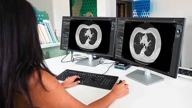 Krankenhausmitarbeitende nutzen mint Lesion für interoperable Workflows und Datenmanagement im Lungenkrebsscreening