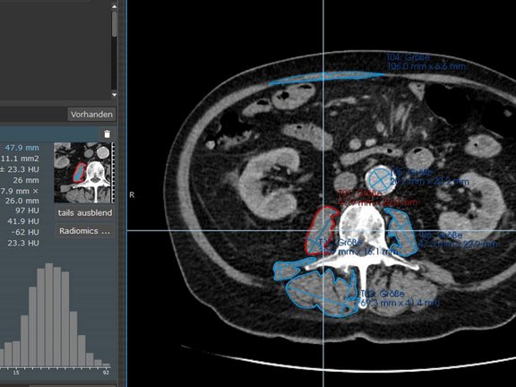 mint Lesion screenshot with segmented muscles and radiomics