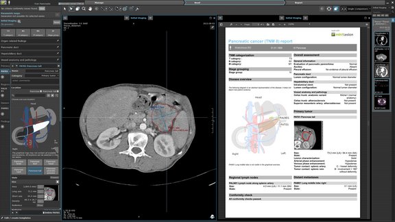 Der user interface von mint Lesion™ zeigt einen abdominalen MRT-Scan im DICOM-Viewer und einen automatisch erstellten Befundbericht nach TNM 8 zum Bauchspeicheldrüsenkrebs.