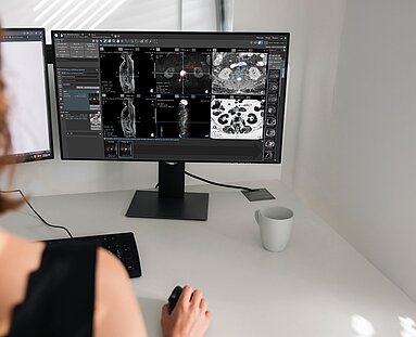 Radiologe analysiert Ganzkörper-MRT-Aufnahmen von Knochenmetastasen beim Prostatakarzinom mit KI-gestützter Tumorlastquantifizierung in mint Lesion