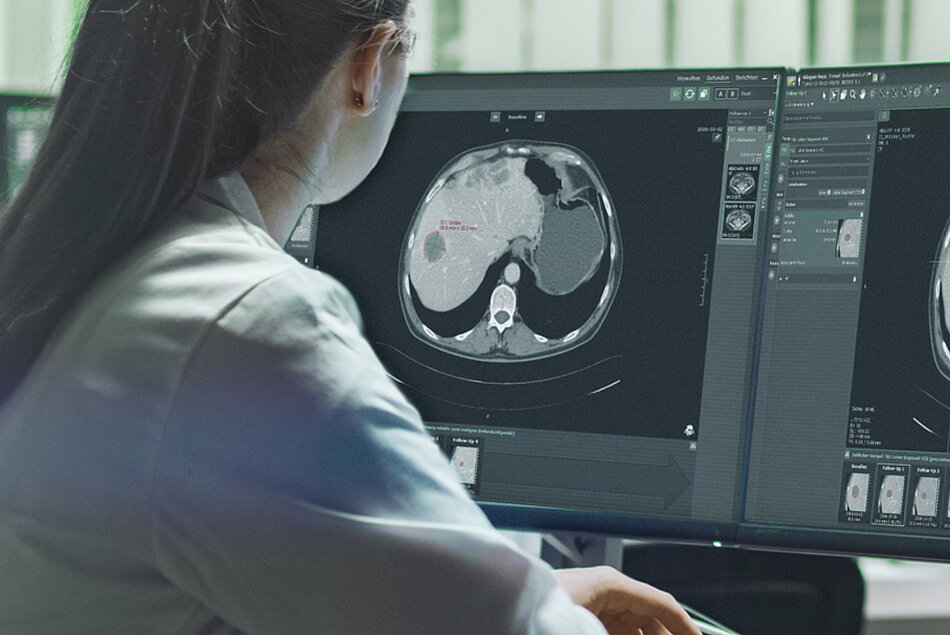 Radiologist performs a tumor response evaluation read in line with iRECIST and analyze the frequency of different criteria used in clinical trials