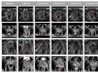 Image showing MR image analysis using the dedicated semiautomatic software tool mint Lesion™