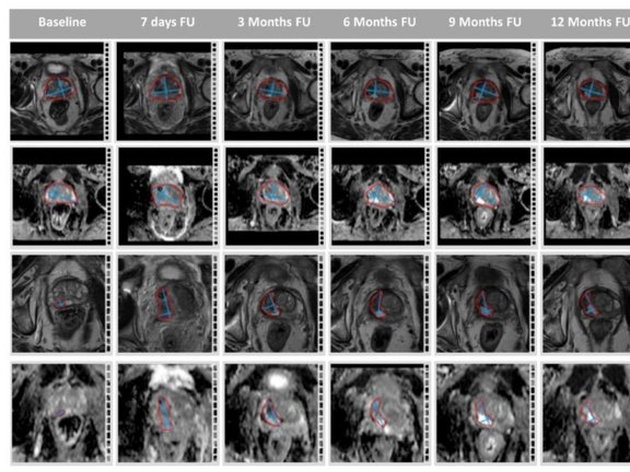 Image showing MR image analysis using the dedicated semiautomatic software tool mint Lesion™