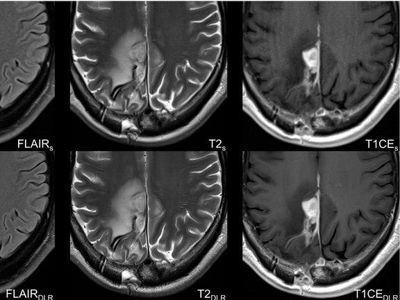 Three important sequences (FLAIR, T2, T1 with contrast agent) in the assessment of glioblastoma