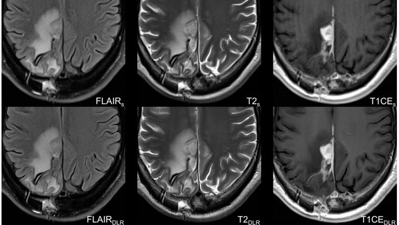 Three important sequences (FLAIR, T2, T1 with contrast agent) in the assessment of glioblastoma