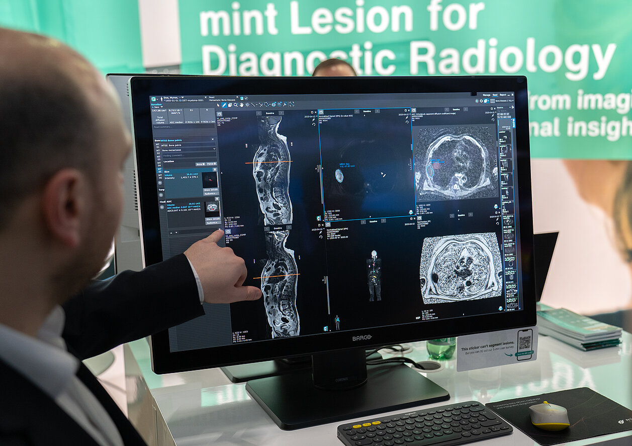 Radiologe analysiert Ganzkörper-MRT-Aufnahmen eines Multiplen Myeloms mit KI-gestützter Quantifizierung in mint Lesion