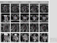 Image showing MR image analysis using the dedicated semiautomatic software tool mint Lesion™