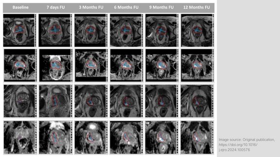 Image showing MR image analysis using the dedicated semiautomatic software tool mint Lesion™