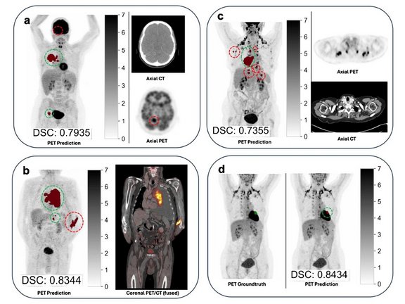 PET scans of torso with relevant false positives highlighted by red dotted circles, true positives in green