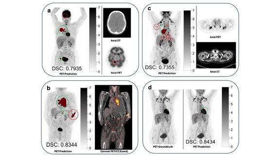 PET scans of torso with relevant false positives highlighted by red dotted circles, true positives in green