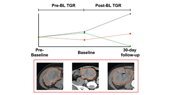 Ein Diagramm und ein CT-Scan zur Darstellung der Tumorwachstumsrate bei Patienten mit refraktärem oder rezidivierendem Lymphom