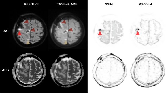 Postoperative Hirntumor-MRT mit Vergleich von TGSE-BLADE und RESOLVE DWI zur Darstellung von Artefakten und Resektionsareal