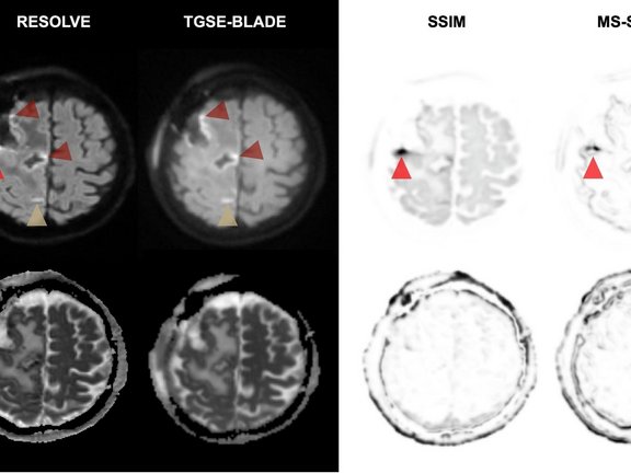 Postoperative Hirntumor-MRT mit Vergleich von TGSE-BLADE und RESOLVE DWI zur Darstellung von Artefakten und Resektionsareal