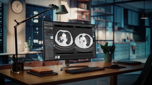 Oncologic imaging: lung cancer screening in mint Lesion