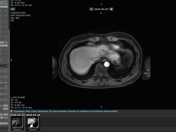 mint Lesion screenshot with HCC diagnosis according to APASL, AASLD, LI-RADS, KLCA-NCC, and EASL guidelines