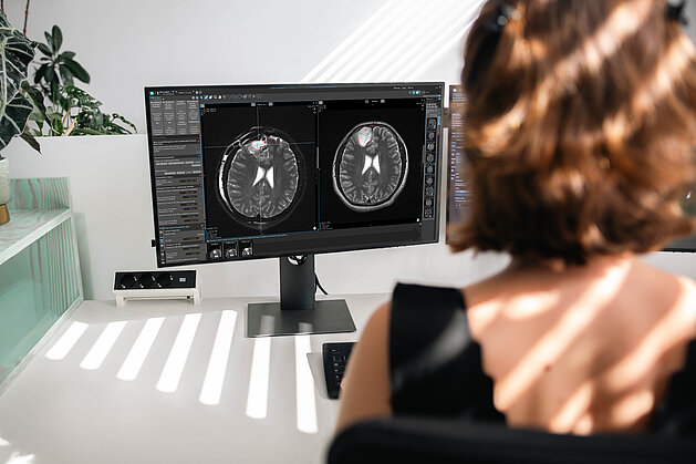 Screenshot of the mint Lesion interface showing RANO 2.0 configuration, tumor burden calculations, and structured neuro-oncology assessment tools.