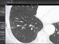 AI lung nodules detection in contextflow and Lung-RADS in mint Lesion