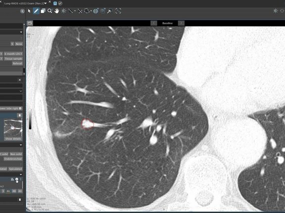 KI-basierte Erkennung von Lungenknoten mit contextflow und Lung-RADS in mint Lesion