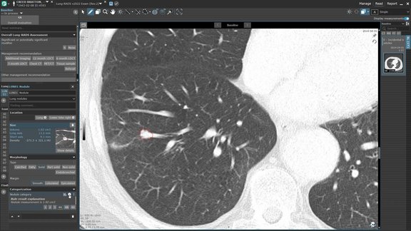 KI-basierte Erkennung von Lungenknoten mit contextflow und Lung-RADS in mint Lesion