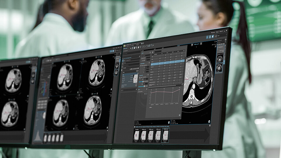 mint Lesion™ zeigt eine longitudinale Auswertung des Ansprechens auf eine onkologische Therapie und Radiomic Parameter