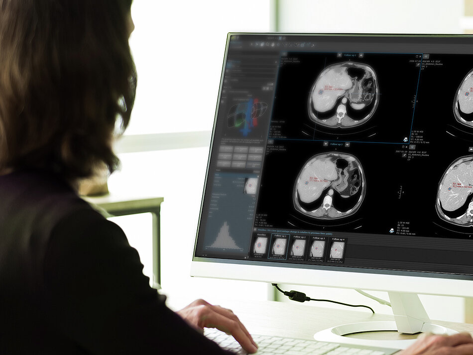 Auswertung von Bilddaten in einer Studie zur Prüfung von Immuntherapeutika im Kontext von iRECIST