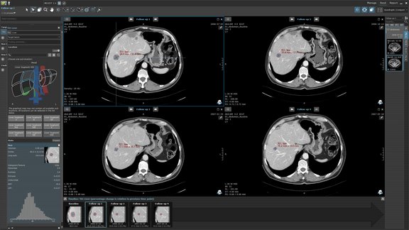 Der mint Lesion™ user interface zeigt die longitudinale Auswertung des Ansprechens auf eine onkologische Therapie im Rahmen einer klinischen Studie