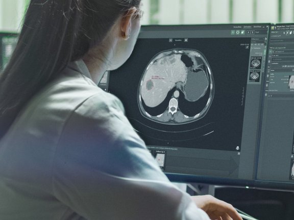 Radiologist performs a tumor response evaluation read in line with iRECIST and analyze the frequency of different criteria used in clinical trials