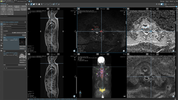 Ein Screenshot aus mint Lesion™ mit Bildern Ganzkörperscans sowie Details der einzelnen Läsionen