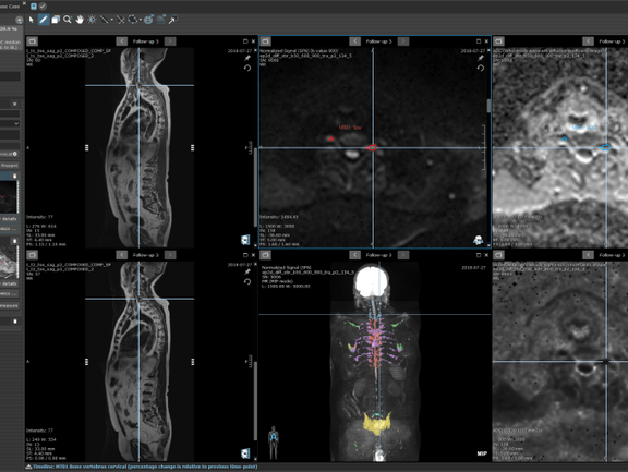 Ein Screenshot aus mint Lesion™ mit Bildern Ganzkörperscans sowie Details der einzelnen Läsionen