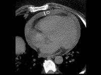 This image shows a scan of pericardial effusion