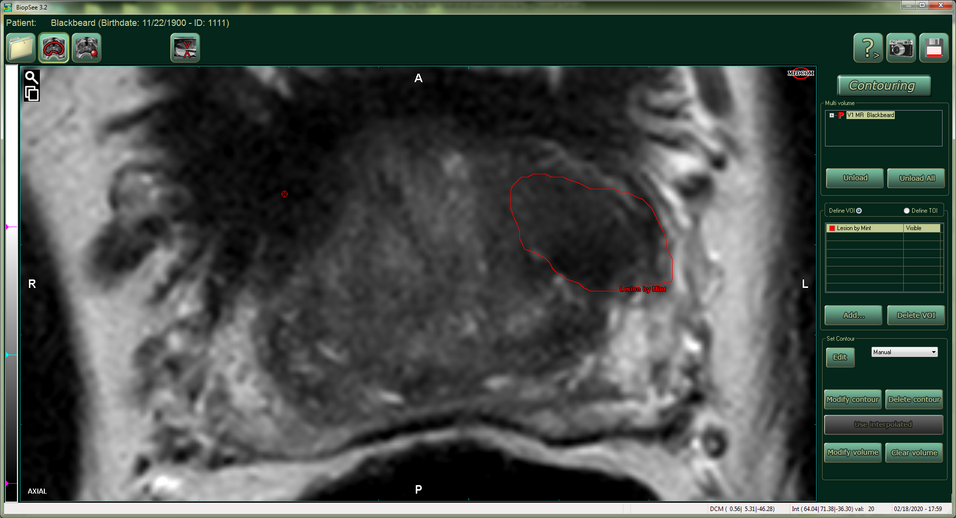 Eine aus mint Lesion exportierte Läsionskontur, dargestellt in der BiopSee®-Software.