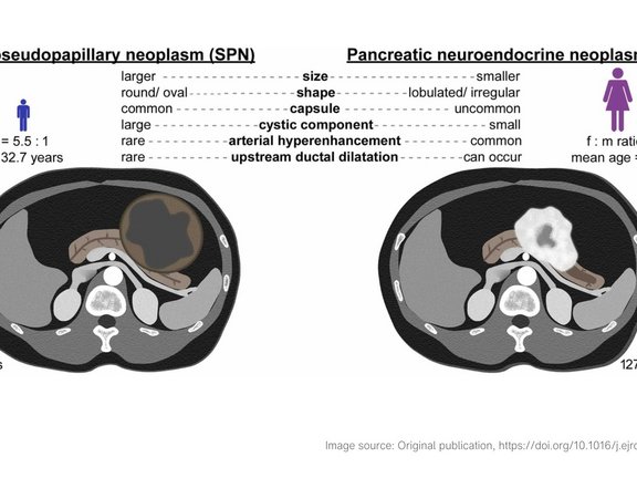 Illustrations of solid pseudopapillary neoplasms and pancreatic neuroendocrine neoplasms