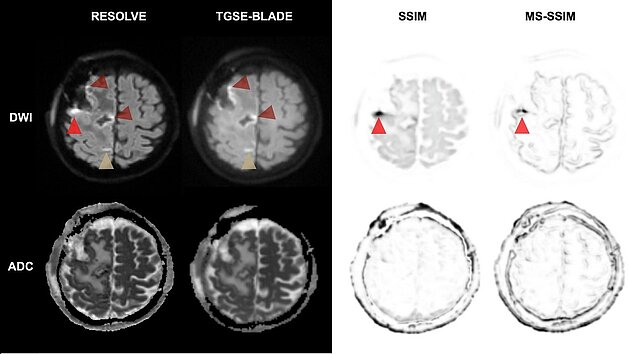 Postoperative Hirntumor-MRT mit Vergleich von TGSE-BLADE und RESOLVE DWI zur Darstellung von Artefakten und Resektionsareal