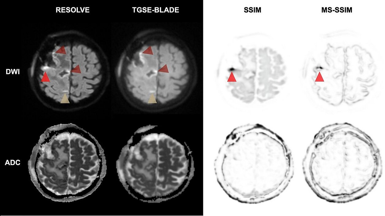 Postoperative brain tumor MRI comparing TGSE-BLADE and RESOLVE DWI showing distortion reduction near resection site