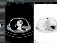 Screenshot der strukturierten Befundungsvorlage für NSCLC Staging