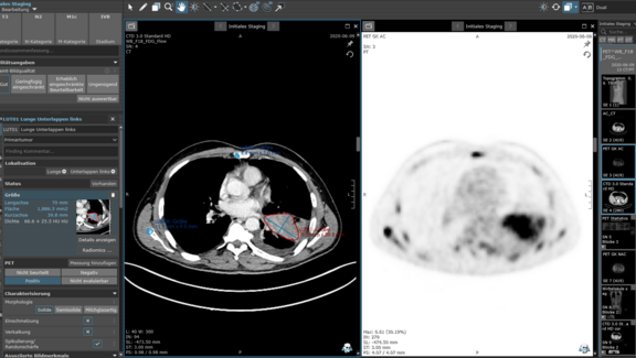 Screenshot der strukturierten Befundungsvorlage für NSCLC Staging