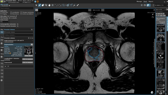 Screenshot of a prostate lesion in mint Lesion