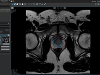 Screenshot of a prostate lesion in mint Lesion