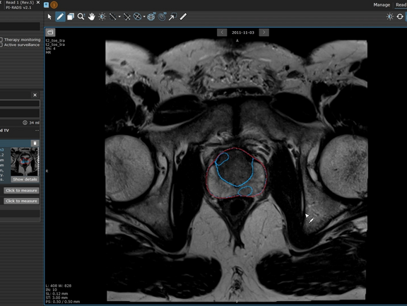 Screenshot einer Prostataläsion in mint Lesion