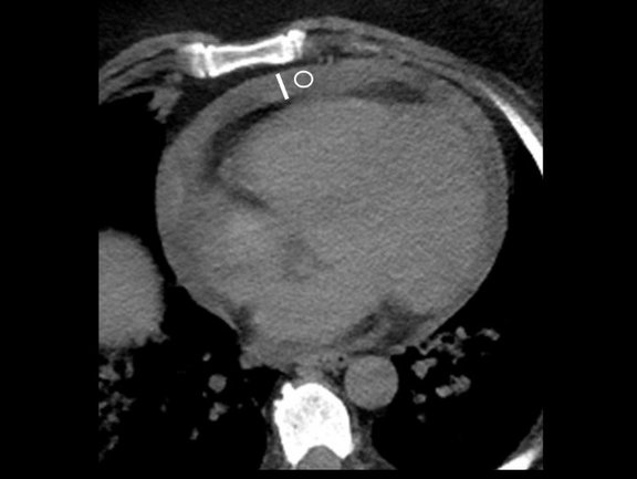 Picture shows a scan of pericardial effusion