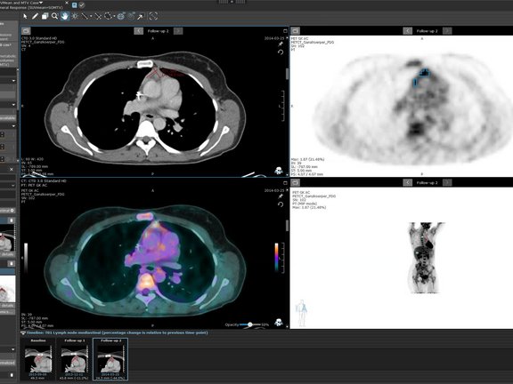 mint Lesion Screenshot mit PET-Auswertung, SUV und angepassten Response-Kriterien